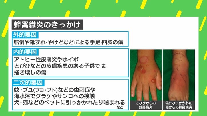 【写真・画像】蚊に刺されて入院? 放置厳禁の「蜂窩織炎」とは? 転倒・靴ずれ・クラゲもきっかけに 3枚目
