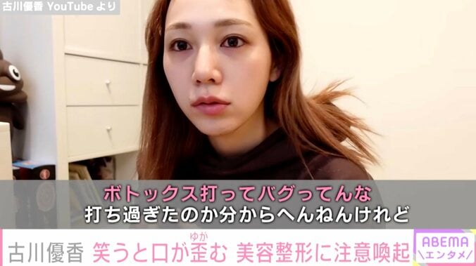 「ボトックスしたら顔バグった話」YouTuber古川優香、美容整形に注意喚起 歪んでしまった口元を公開 1枚目