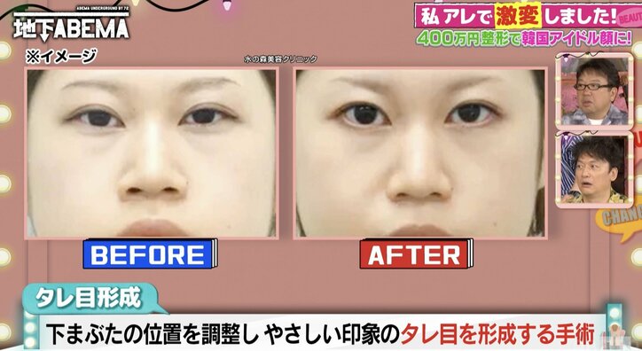 【写真・画像】まぶたを開く筋肉の働きを調整し目を開きやすく…人気の整形「目つき矯正」に驚きの声「そんなことしていいの！？」　2枚目