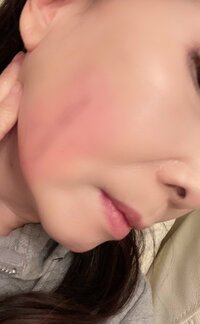 アグネス・チャン『跡が残りそう⁉️』