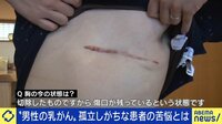 女性だけでない“男性乳がん”、発症者が語る戸惑いと早期発見の重要性