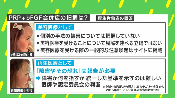 【写真・画像】“若返り注射”でおでこが膨らみ「コブダイ」に！？ 当事者「よくこれで生きてたな。額の限界を感じた…」 PRP＋bFGFとは？　7枚目