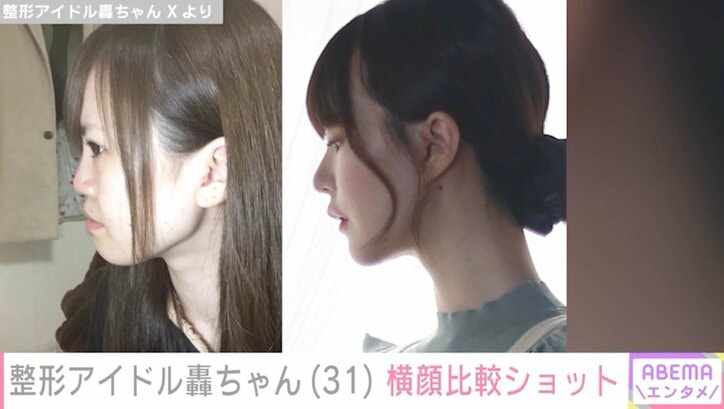 【写真・画像】“総額1350万円超”整形アイドル轟ちゃん「壊滅的な平面横顔からよくぞここまで…」横顔比較ショット公開　1枚目