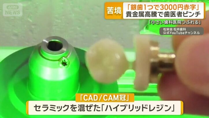 セラミックを混ぜたハイブリッドレジン「CAD/CAM冠」
