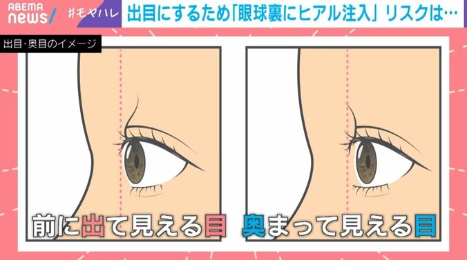 出目と奥目