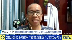 20万人に1人「結合双生児」として生まれたドクさん、今は双子の父に 共に考える障害者の子を持つ重さと尊さ