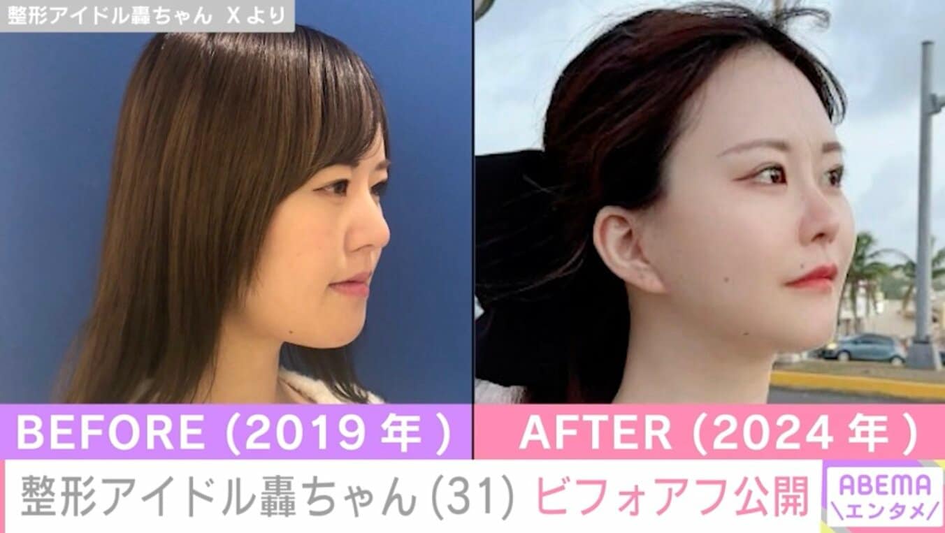 【写真・画像】“総額1350万円超”整形アイドル轟ちゃん、ビフォーアフター公開「普通の輪郭になれました」 1枚目 | エンタメ総合 ...