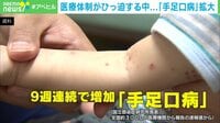 医療体制がひっ迫する中...「手足口病」拡大