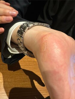 永瀬拓矢九段の左手にできた“対局タコ”