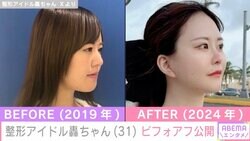 “総額1350万円超”整形アイドル轟ちゃん、ビフォーアフター公開「普通の輪郭になれました」