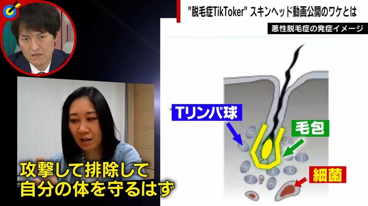 高校2年で髪が抜け落ちた女性 包み隠さず“脱毛症生活”を発信 彼女を前向きにした恋人の言葉