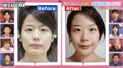 1回16万5000円…小顔矯正のビフォーアフターに衝撃「骨格が全然違う！」