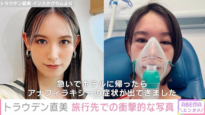トラウデン直美、スペイン旅行中にアナフィラキシー発症「大変なことが起こりました」顔面が腫れた写真公開 2枚目