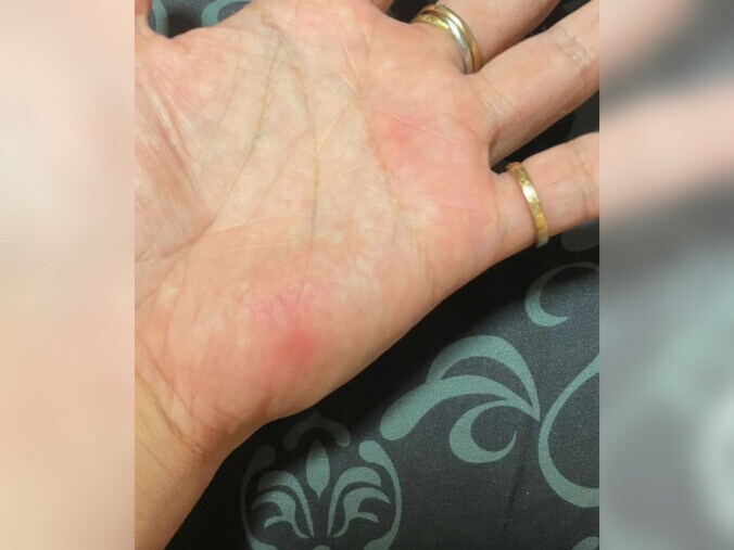 【画像】やけどしてしまった手