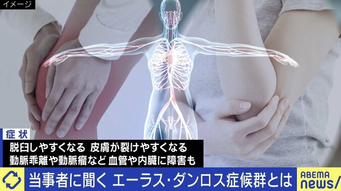 「何もできないと決めつけないで」エーラス・ダンロス症候群とは？ 当事者が明かす症状 9枚目