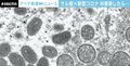 サル痘 米・NY市で急拡大の理由 新型コロナとの“W感染”は「非常に苦しい…」