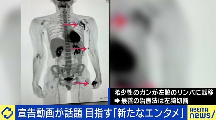 「いじっていいよ」障害者＝笑えない？ 芸人の夢をあきらめ…“かすり傷”きっかけで片腕を失った男性に反響