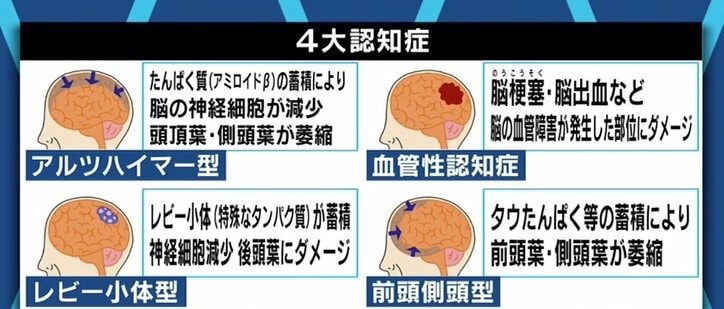 朝起きたら仕事に関する記憶が消失…働き盛りを襲う“若年性認知症” 当事者の苦悩
