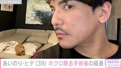 あいのりヒデ、韓国でのホクロ除去手術後の経過と値段を明かす「めちゃ安い！」