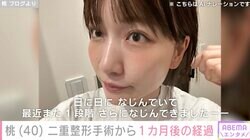 3度目の二重整形・あいのり桃（40）、手術から1カ月後の経過を公開「目が元気になった！やってよかった」