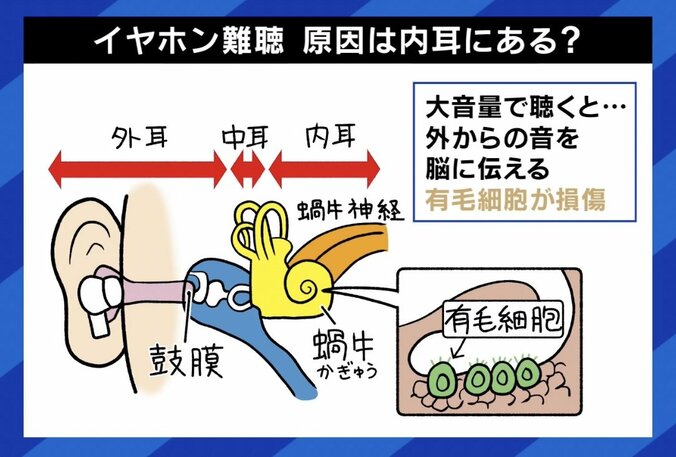 【写真・画像】「1日7、8時間ぐらい爆音で…」 耳の痛みや頭痛などの“イヤホン難聴”に 二度と回復しない？ WHOは「11億人がリスクに」と警告　3枚目