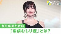 【映像】有村藍里も悩む「皮膚むしり症」 経験者＆専門家が明かす対処法