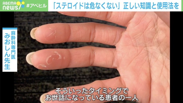 ステロイドは“怖くない” 専門医が語る正しい知識と使用法「副作用を十分知ったうえで必要なタイミングで投与」