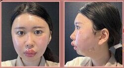 1500万円でアイドル顔を手にいれた美女、骨切りダウンタイム中の姿に驚きの声「いつ人間に戻れるのか不安でした」