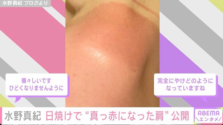 水野真紀、日焼けで真っ赤になった体を公開「痛々しい」「完全にやけどのようになっていますね」ファンから心配の声