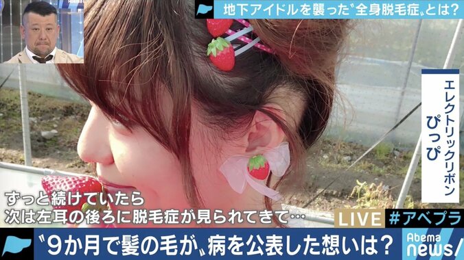 「頭が丸くても続けたい」…全身脱毛症アイドル、告白の裏にファンの後押しも 3枚目