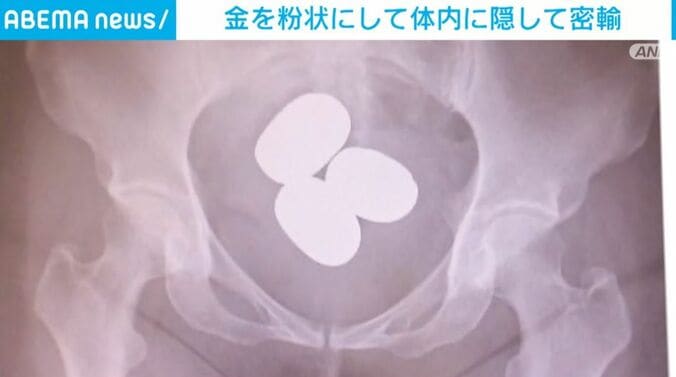 体内に隠された金