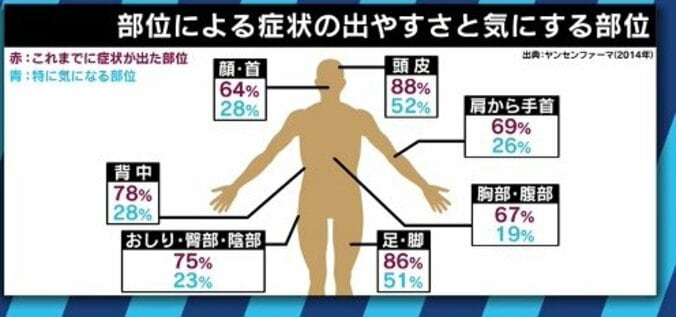 患者が告白「結婚は難しいと言われショックを受けた」　道端アンジェリカも誤解と偏見に苦しむ「乾癬」とは 9枚目