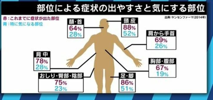 患者が告白「結婚は難しいと言われショックを受けた」 道端アンジェリカも誤解と偏見に苦しむ「乾癬」とは