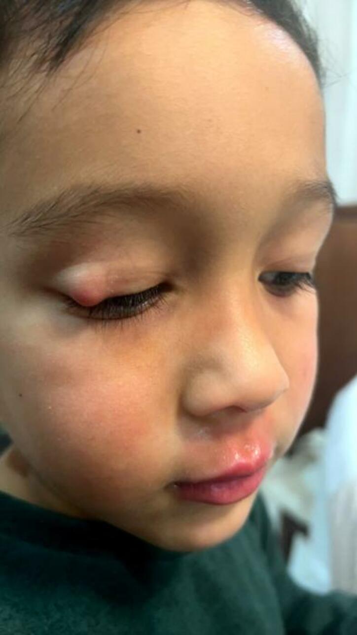  ラミレスの妻、次男の瞼が赤く大きく腫れ病院を受診「切開の可能性有りだそうで、、」 