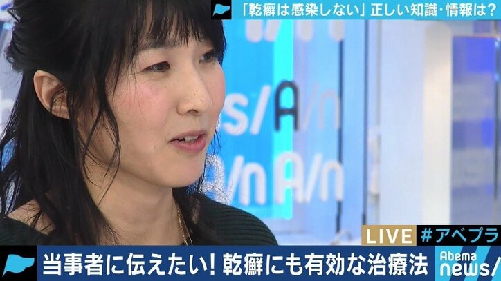 患者が告白「結婚は難しいと言われショックを受けた」 道端アンジェリカも誤解と偏見に苦しむ「乾癬」とは