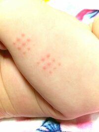 山口美沙『BCG3日目』