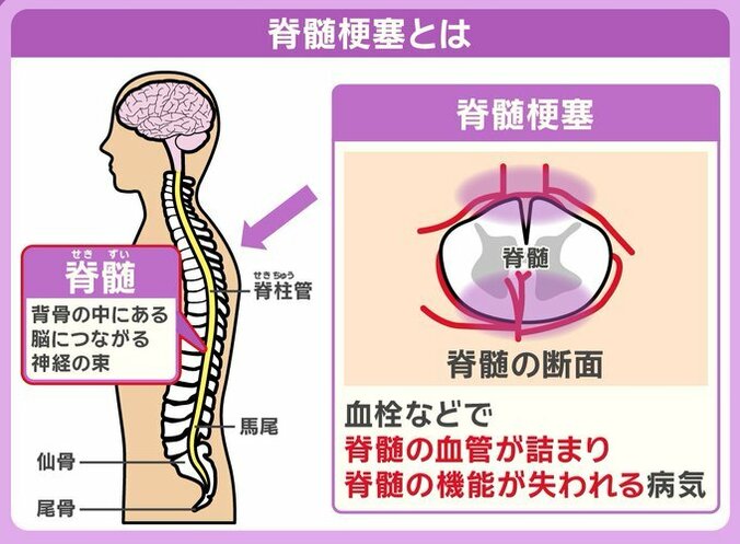 脊髄梗塞とは