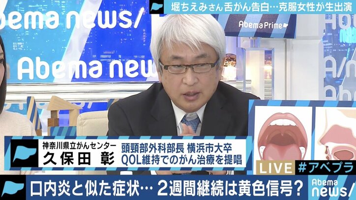 堀ちえみが「舌がん」告白…専門医「２週間以上続く口内炎は受診を」