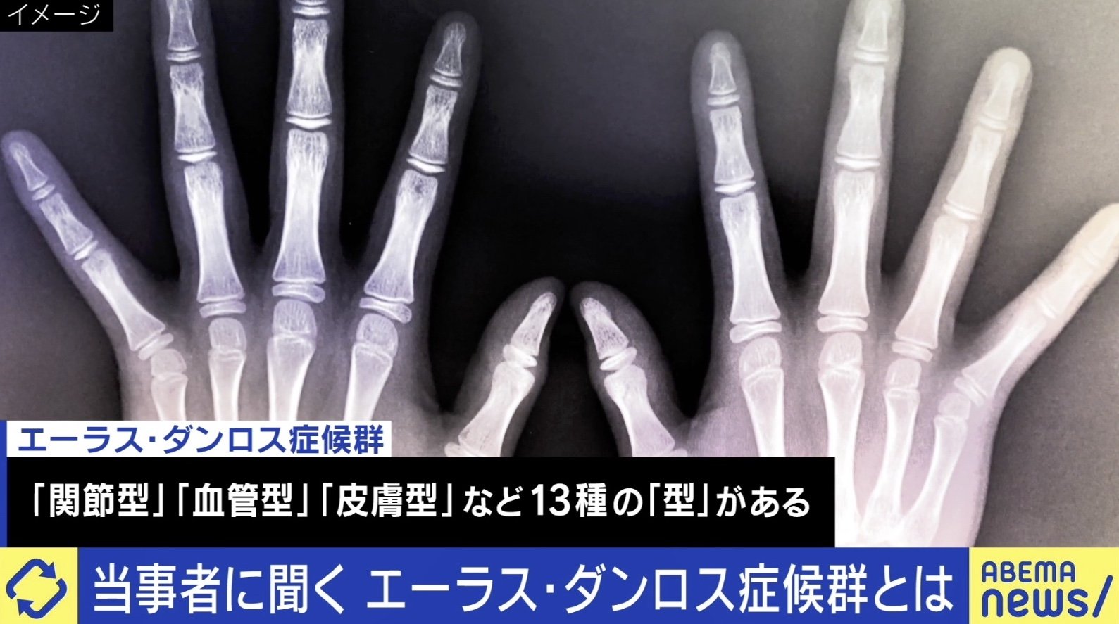 EDSと子宮内膜症の間には関係がありますか?