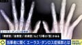 「何もできないと決めつけないで」エーラス・ダンロス症候群とは？ 当事者が明かす症状