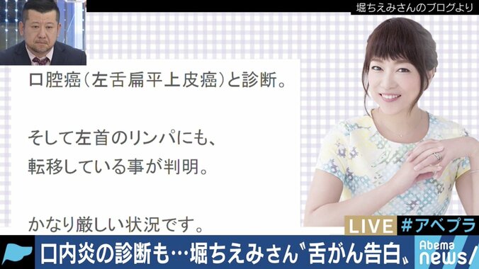 堀ちえみが「舌がん」告白…専門医「２週間以上続く口内炎は受診を」 7枚目
