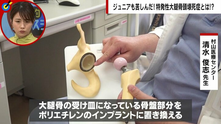 「両方の股関節と膝が壊死した」女優を目指した若い女性の告白 発症率5万人に1人の難病は「反対にへし折られている痛み」