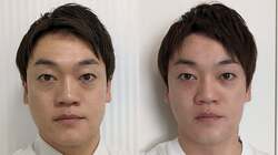  おばたのお兄さん、98万円かけて整形した自身のビフォーアフターを公開「めちゃくちゃ痛かった！」 