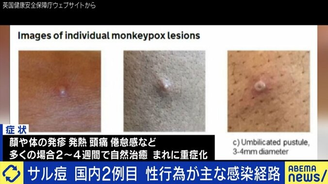 日本でも感染確認の「サル痘」、男性同性愛者への差別や偏見を生じさせない注意喚起を 6枚目