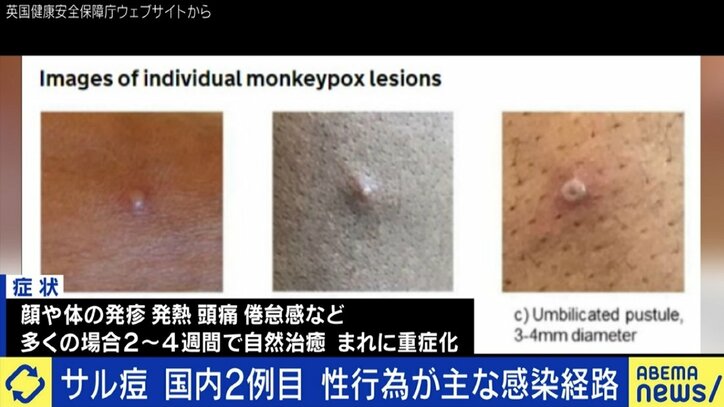 日本でも感染確認の「サル痘」、男性同性愛者への差別や偏見を生じさせない注意喚起を