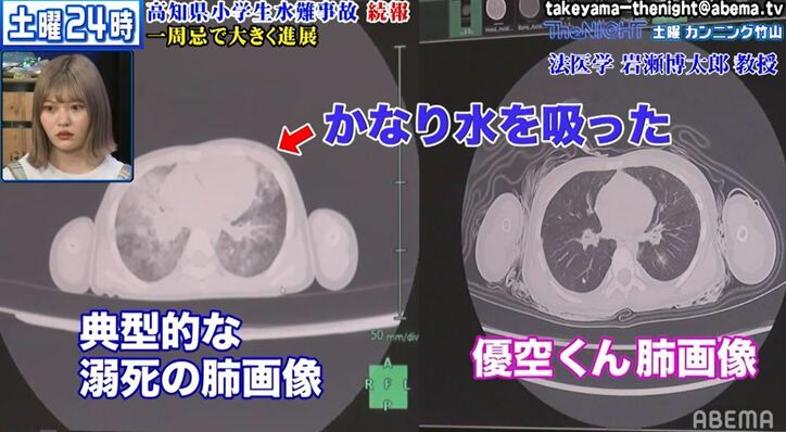法医学の教授が高知県小学生水難事故で亡くなった小学生のCT画像に見解