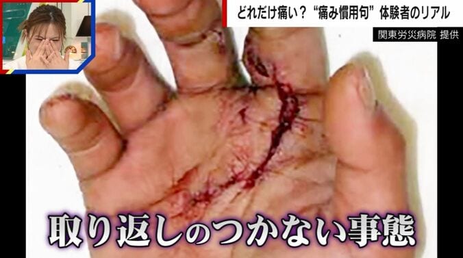 実際に飼い犬に手を噛まれた人の写真