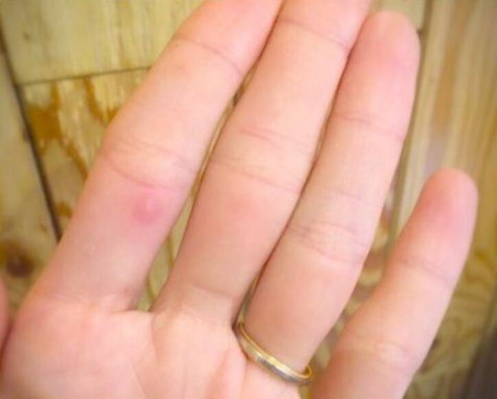 おかもとまり　手足口病を疑う「「喉も乾くし、痛いし、身体もだるい」