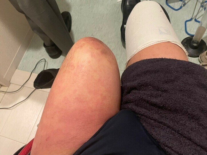 【画像】赤みの残る山田さんの足