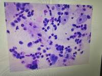 高須克弥『癌細胞めっけ。』